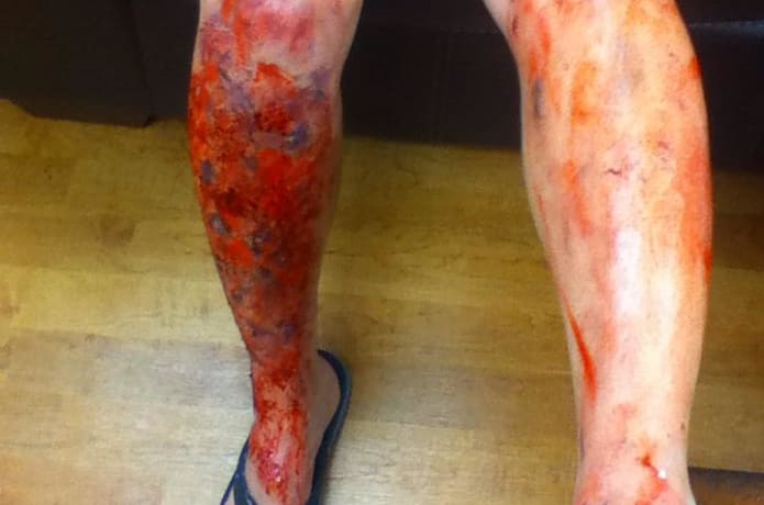 Second- and third-degree burns, and bleeding scrapes.