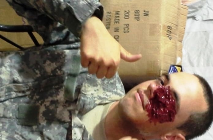 Shrapnel wounds.