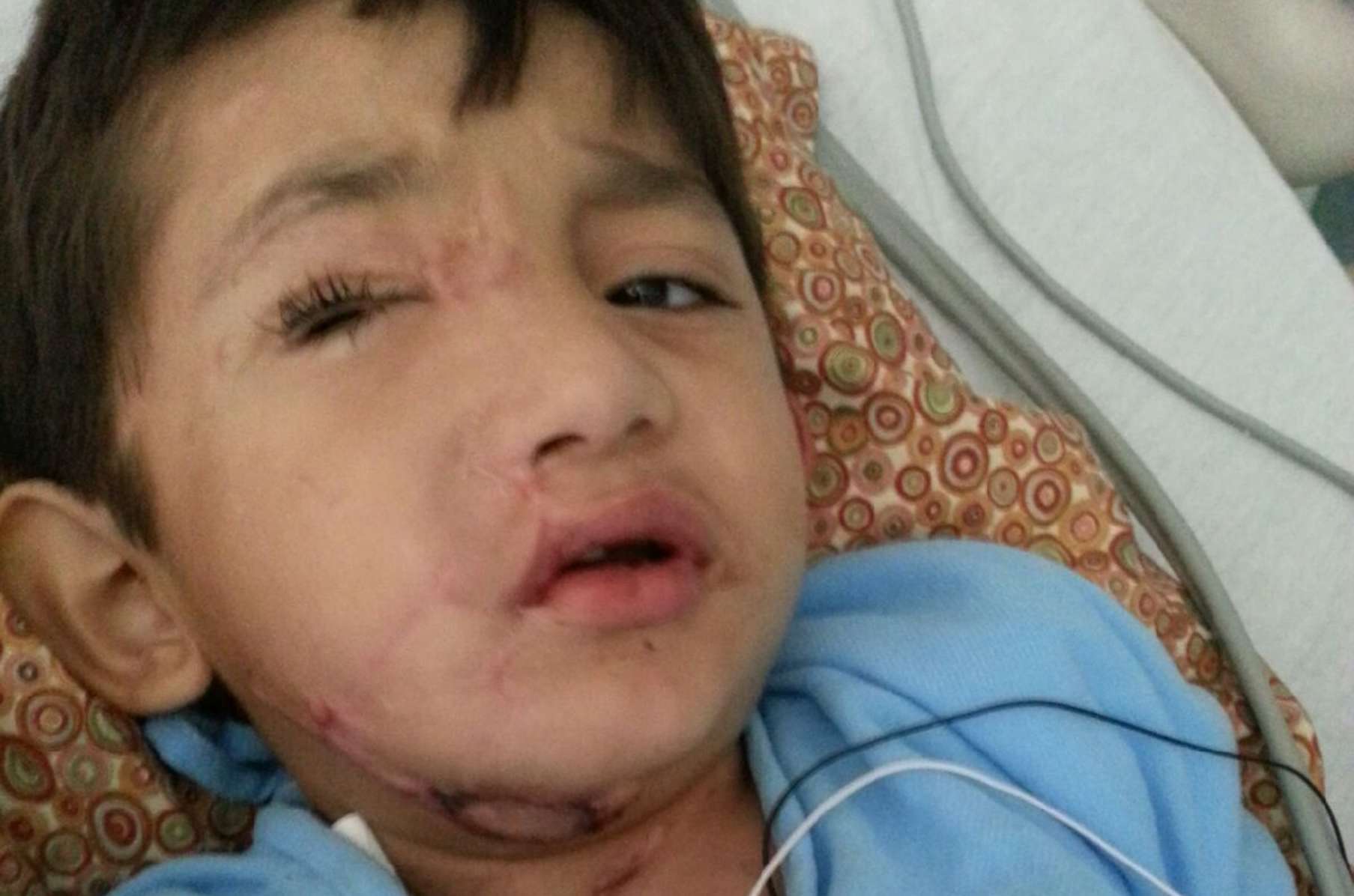 kevin vicente victim of pitbull attack