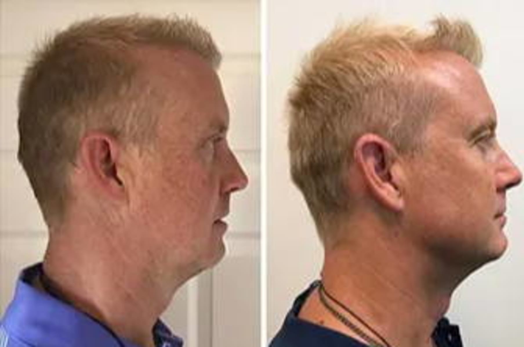 Jawline exercise clearance ball